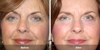 Eyelid Lift Before & After Gallery - Patient 108718 - Image 1