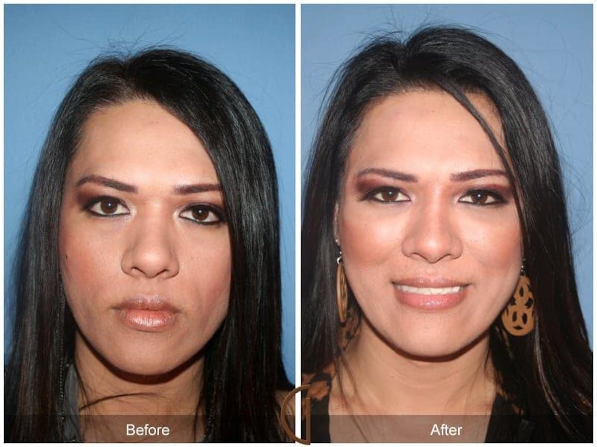 Facial Fat Grafting Before & After Gallery - Patient 637341 - Image 2