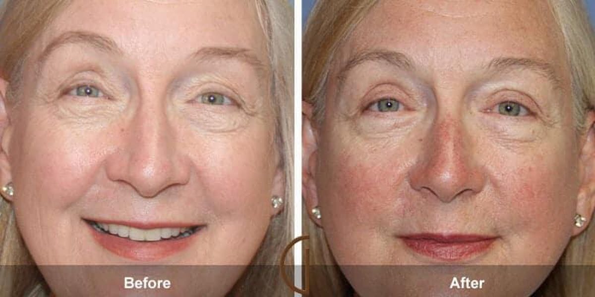 Eyelid Lift Before & After Gallery - Patient 204087 - Image 1
