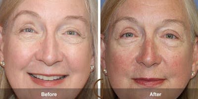 Eyelid Lift Before & After Gallery - Patient 204087 - Image 1