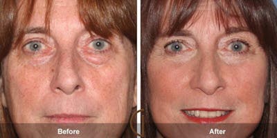 Eyelid Lift Before & After Gallery - Patient 302939 - Image 1