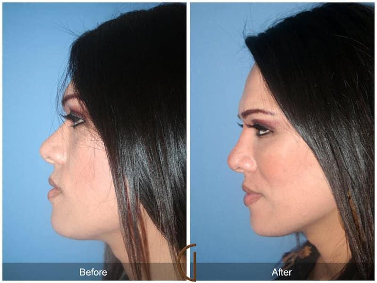 Facial Fat Grafting Before & After Gallery - Patient 637341 - Image 1