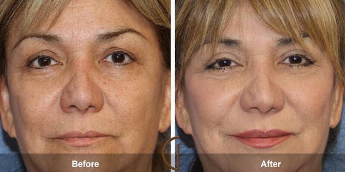 Eyelid Lift Before & After Gallery - Patient 309184 - Image 1