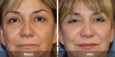 Eyelid Lift Before & After Gallery - Patient 309184 - Image 1
