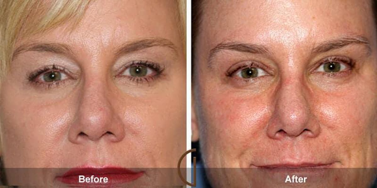 Eyelid Lift Before & After Gallery - Patient 696492 - Image 1