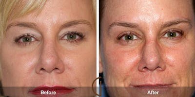 Eyelid Lift Before & After Gallery - Patient 696492 - Image 1