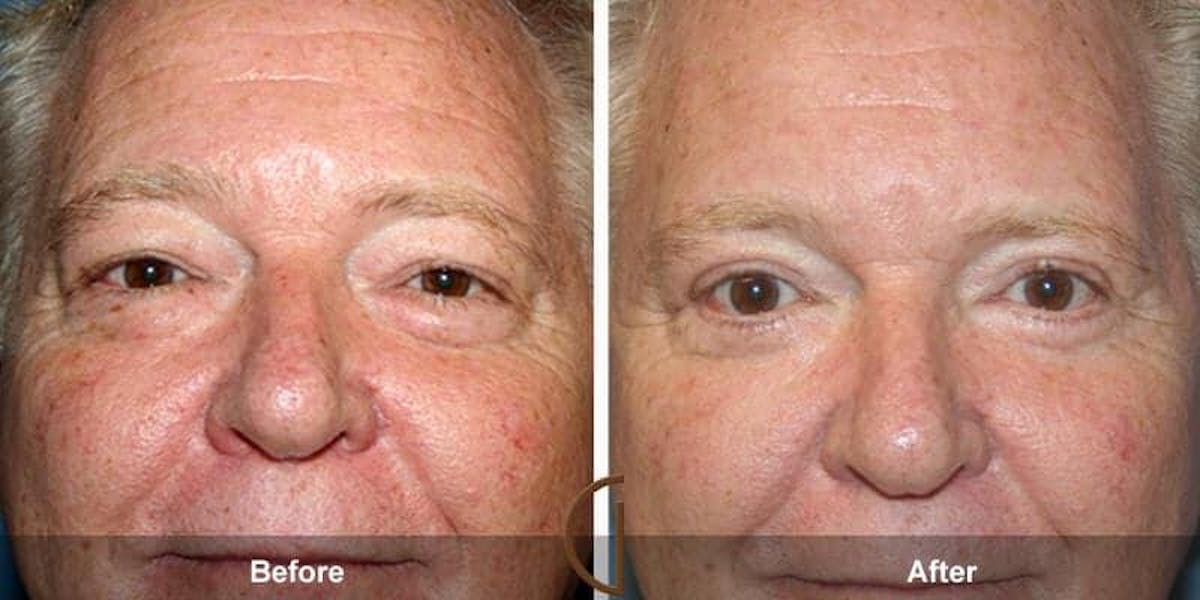 Eyelid Lift Before & After Gallery - Patient 291451 - Image 1