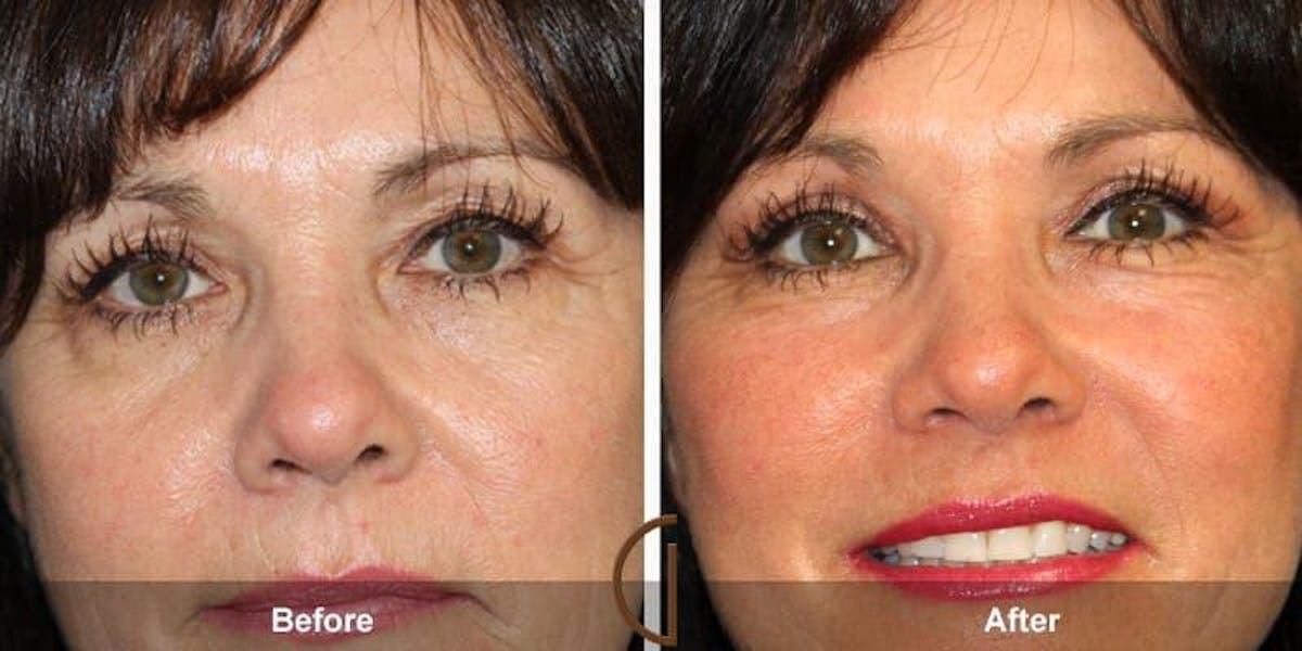 Eyelid Lift Before & After Gallery - Patient 295356 - Image 1
