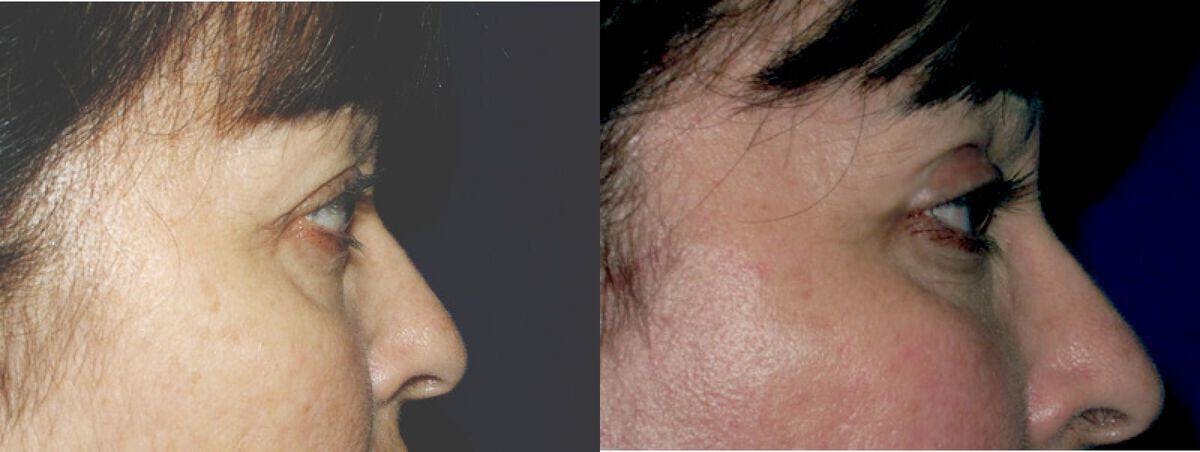 Eyelid Lift Before & After Gallery - Patient 379319 - Image 1