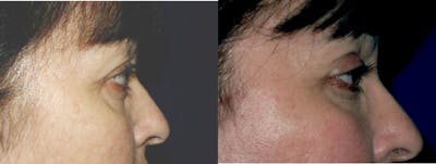 Eyelid Lift Before & After Gallery - Patient 379319 - Image 1