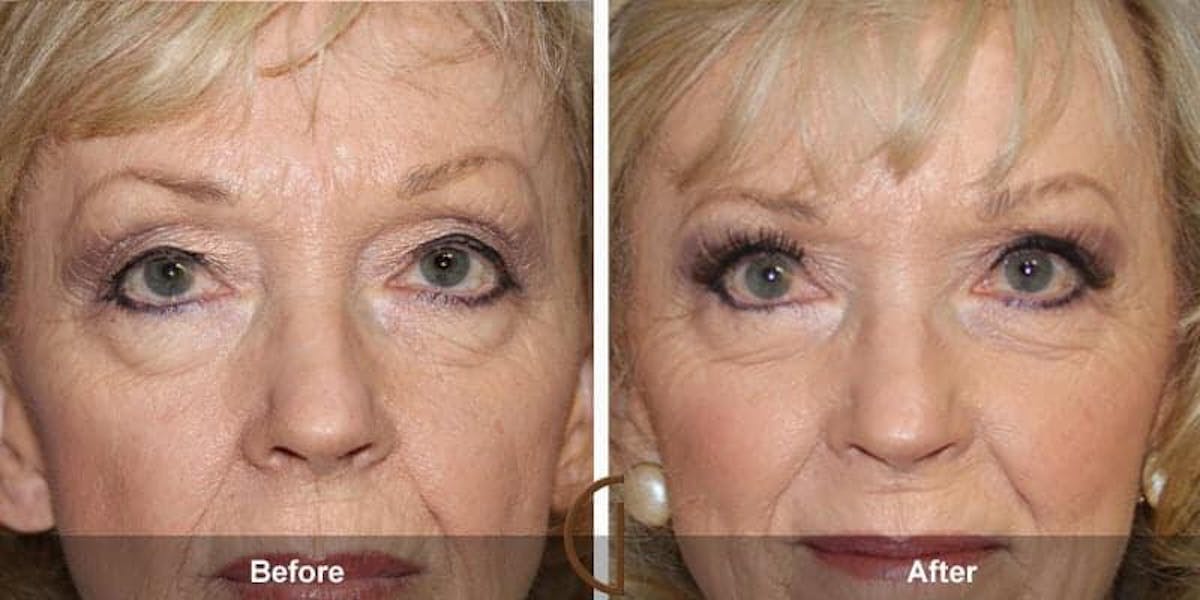 Eyelid Lift Before & After Gallery - Patient 253688 - Image 1