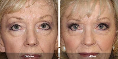 Eyelid Lift Before & After Gallery - Patient 253688 - Image 1