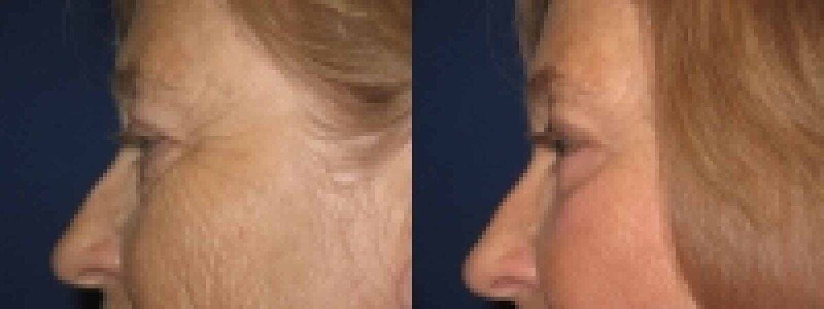 Eyelid Lift Before & After Gallery - Patient 120426 - Image 1