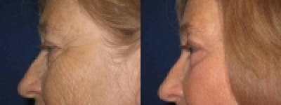 Eyelid Lift Before & After Gallery - Patient 120426 - Image 1