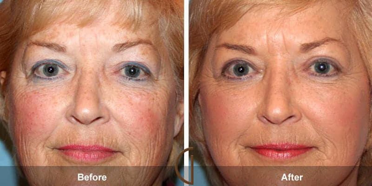 Eyelid Lift Before & After Gallery - Patient 167084 - Image 1
