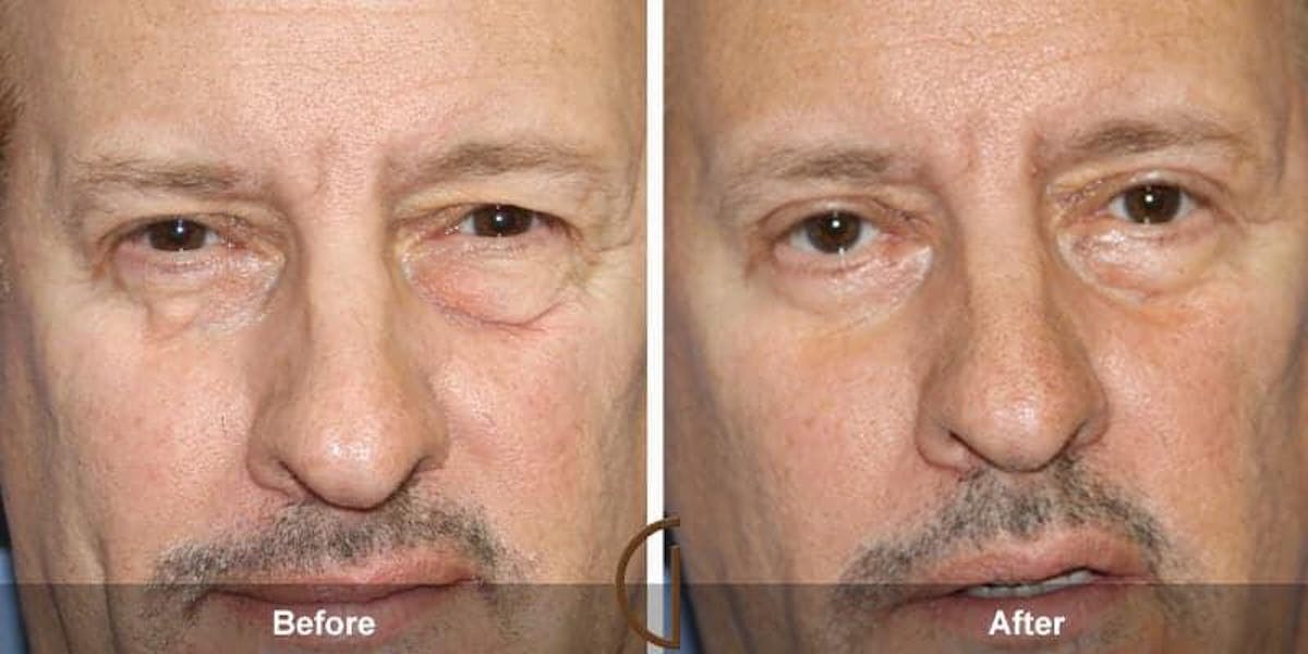 Eyelid Lift Before & After Gallery - Patient 232843 - Image 1
