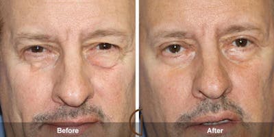 Eyelid Lift Before & After Gallery - Patient 232843 - Image 1
