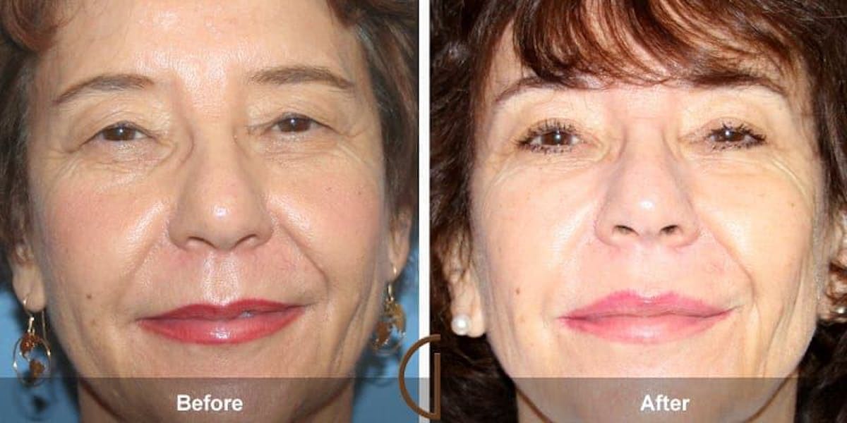 Eyelid Lift Before & After Gallery - Patient 104720 - Image 1
