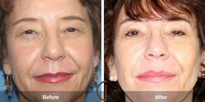 Eyelid Lift Before & After Gallery - Patient 104720 - Image 1
