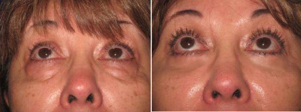 Eyelid Lift Before & After Gallery - Patient 423601 - Image 1