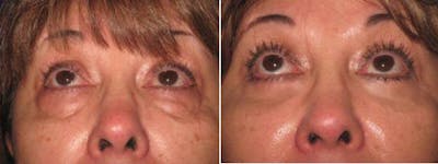 Eyelid Lift Before & After Gallery - Patient 423601 - Image 1