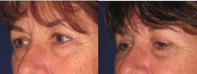Eyelid Lift Before & After Gallery - Patient 194035 - Image 1