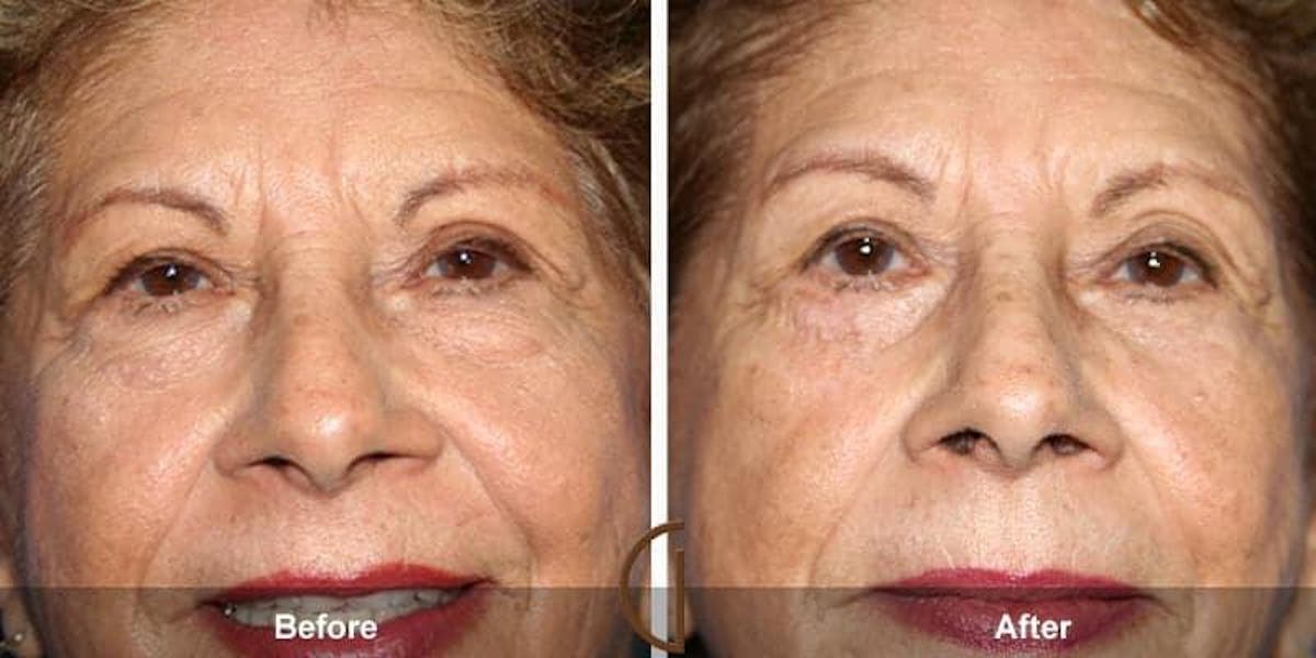 Eyelid Lift Before & After Gallery - Patient 404719 - Image 1