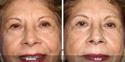 Eyelid Lift Before & After Gallery - Patient 404719 - Image 1