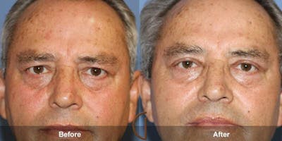 Eyelid Lift Before & After Gallery - Patient 395929 - Image 1