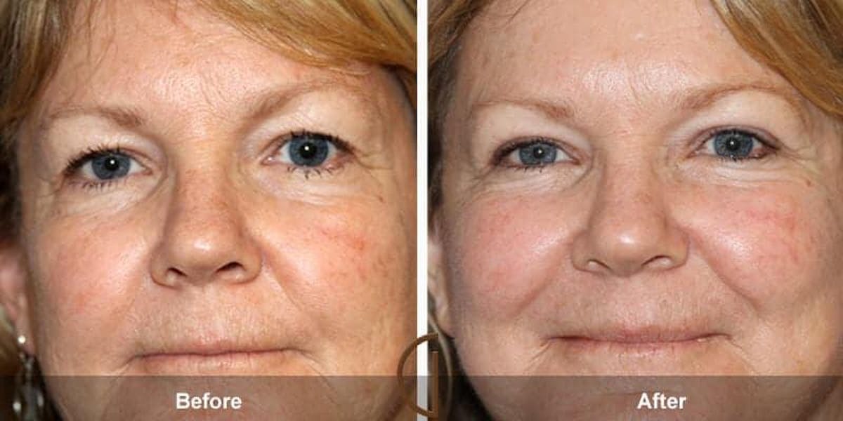 Eyelid Lift Before & After Gallery - Patient 354677 - Image 1