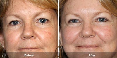 Eyelid Lift Before & After Gallery - Patient 354677 - Image 1