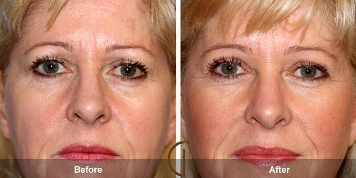 Eyelid Lift Before & After Gallery - Patient 113394 - Image 1