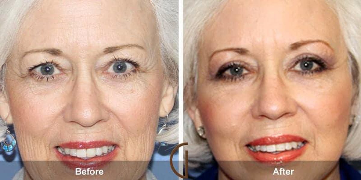 Eyelid Lift Before & After Gallery - Patient 139291 - Image 1