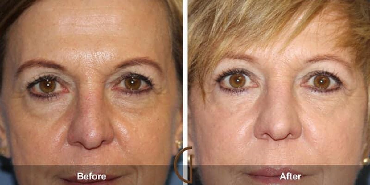 Eyelid Lift Before & After Gallery - Patient 266504 - Image 1
