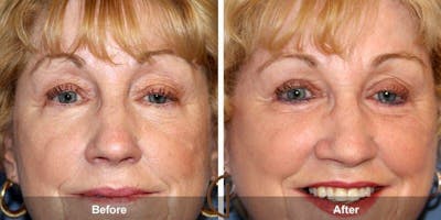 Eyelid Lift Before & After Gallery - Patient 273272 - Image 1