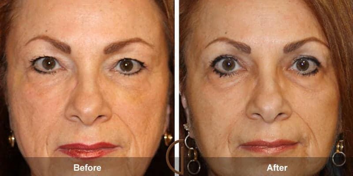 Eyelid Lift Before & After Gallery - Patient 413542 - Image 1