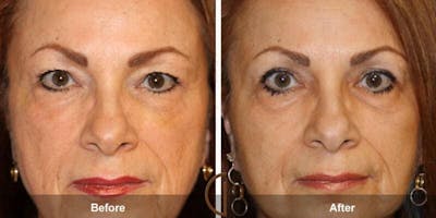 Eyelid Lift Before & After Gallery - Patient 413542 - Image 1