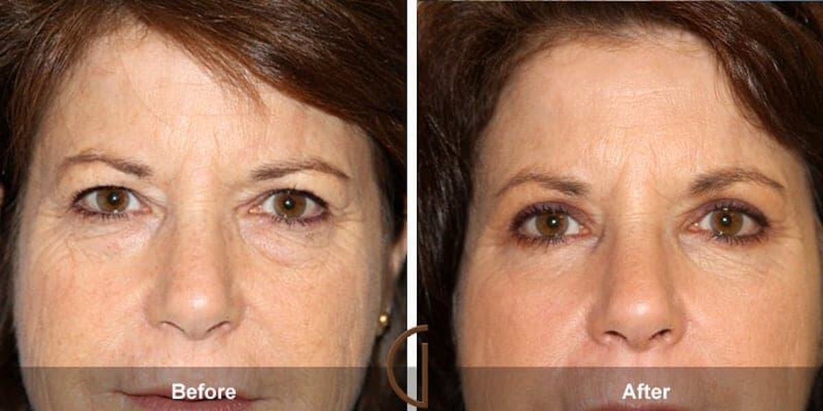 Eyelid Lift Before & After Gallery - Patient 269598 - Image 1