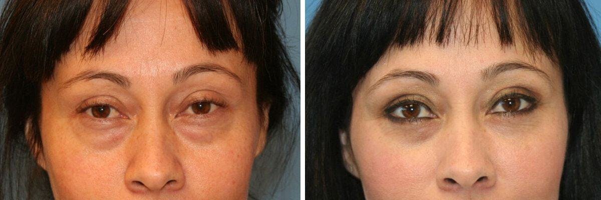 Eyelid Lift Before & After Gallery - Patient 366067 - Image 1