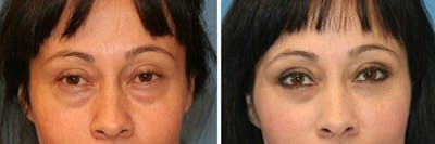 Eyelid Lift Before & After Gallery - Patient 366067 - Image 1