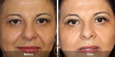 Eyelid Lift Before & After Gallery - Patient 368894 - Image 1