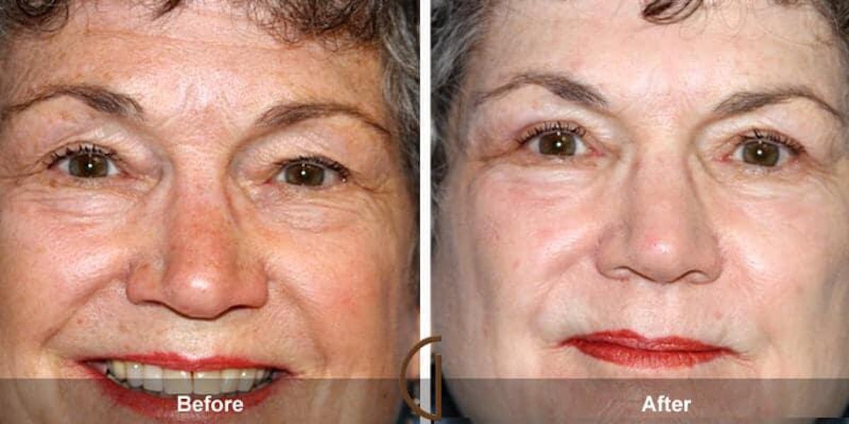 Eyelid Lift Before & After Gallery - Patient 389921 - Image 1