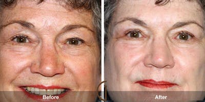 Eyelid Lift Before & After Gallery - Patient 389921 - Image 1