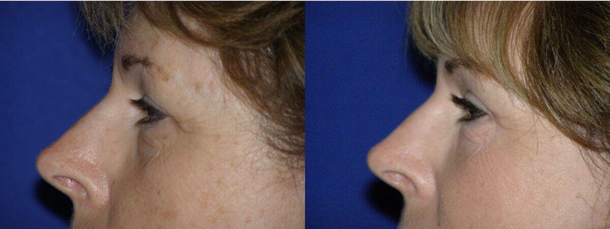 Eyelid Lift Before & After Gallery - Patient 331147 - Image 1