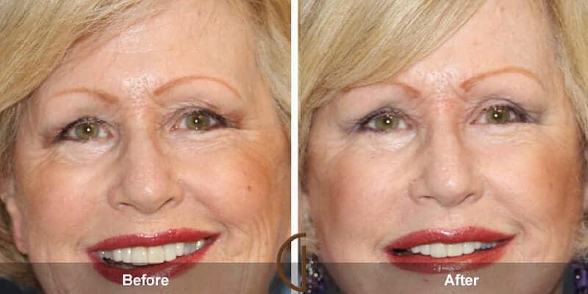 Eyelid Lift Before & After Gallery - Patient 143998 - Image 1