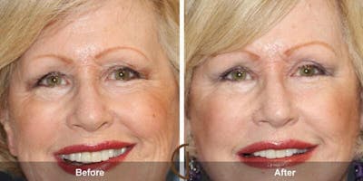 Eyelid Lift Before & After Gallery - Patient 143998 - Image 1