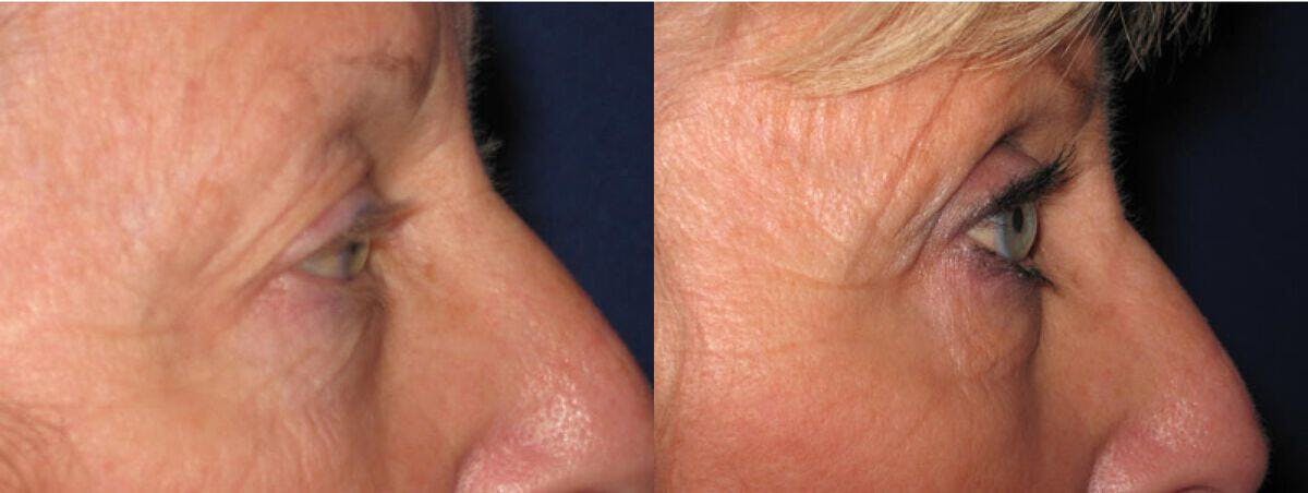 Eyelid Lift Before & After Gallery - Patient 342831 - Image 1