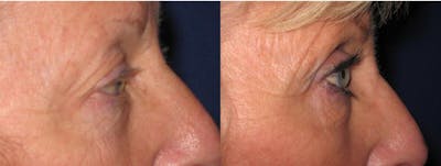 Eyelid Lift Before & After Gallery - Patient 342831 - Image 1