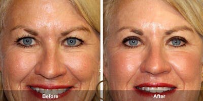 Eyelid Lift Before & After Gallery - Patient 164233 - Image 1