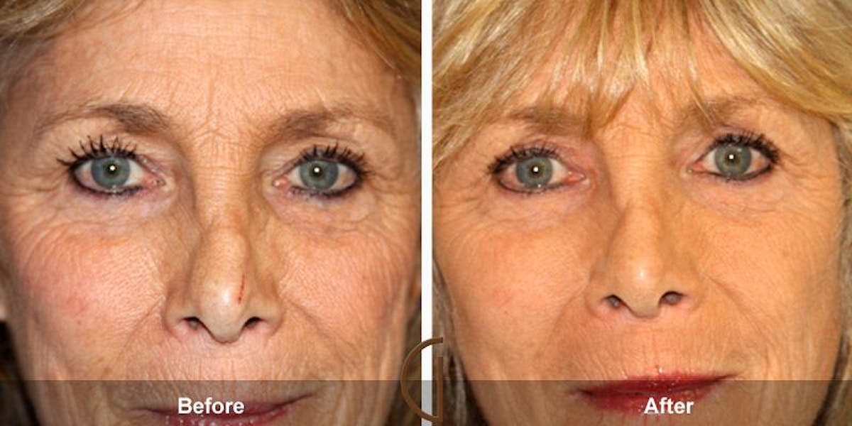 Eyelid Lift Before & After Gallery - Patient 373977 - Image 1
